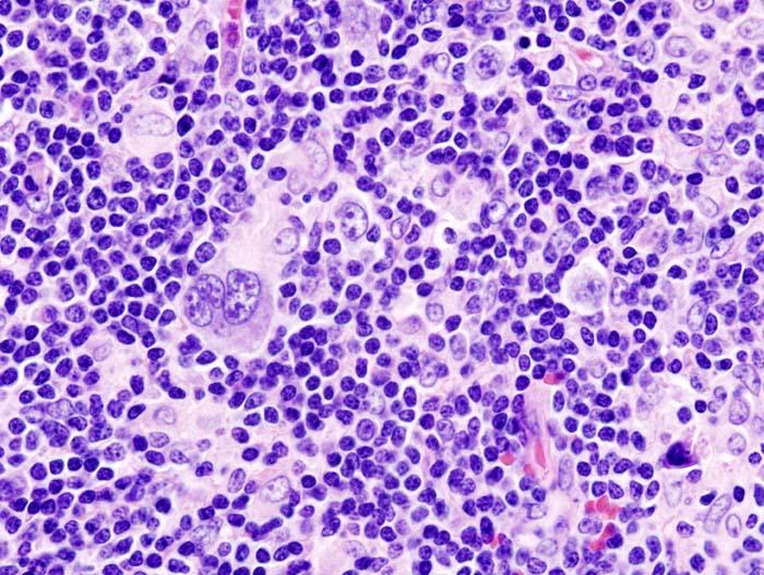 United States Hodgkin's Lymphoma Market Size to Reach US$ 2.1 Billion by 2031 at 9.8% CAGR, Driven by Rising Cancer Prevalence and Advancements in Targeted Therapies | Merck & Co., Inc., Bristol Myers Squibb, F. Hoffmann-La Roche Ltd