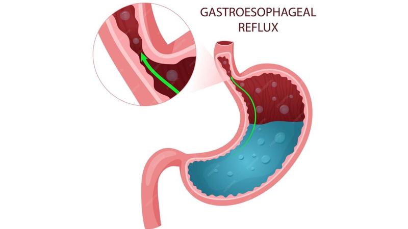 United States Gastroesophageal Reflux Disease (GERD) Therapeutics Market Overview and Growth Outlook 2024-2031