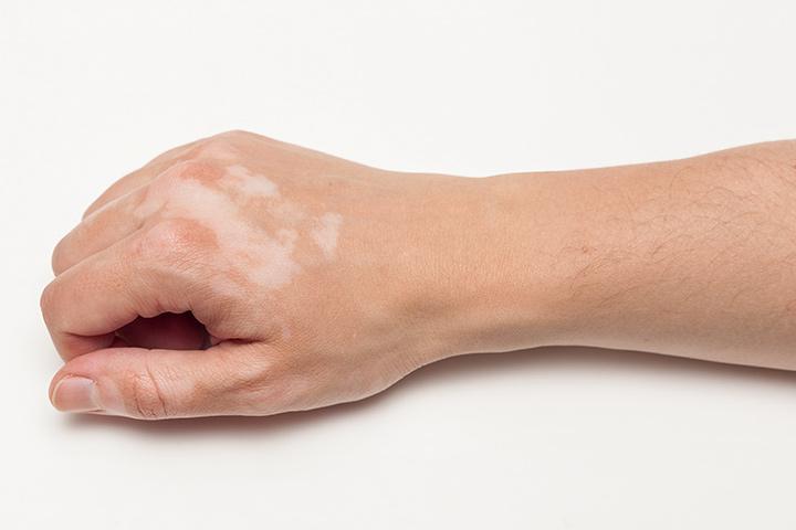 United States Vitiligo Treatment Market Insights 2025-2033: Market Size, Growth Drivers, and Opportunities Beyond US$ 2.4 Billion
