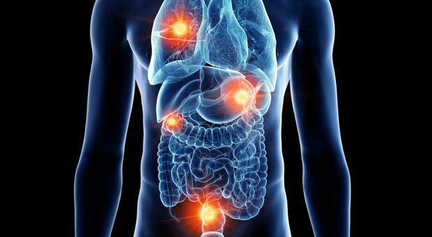 Neuroendocrine Cancer Market to Grow at 10.6% CAGR | Precision Medicine & Targeted Therapies Lead | Novartis AG, Pfizer Inc., Ipsen