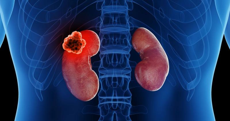 United States Kidney Cancer and Renal Cell Carcinoma Drugs Market to Reach USD 8.9 Billion by 2031, Growing at 6.3% CAGR | Roche Inc, GlaxoSmithKline Plc., Active Biotech Ab.