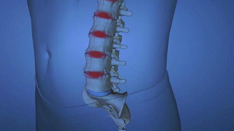 Lumbar Degenerative Disc Disease Market Analysis, Size, Share, and Growth Forecast through 2025-2031 -Sorrento Therapeutics, SpineThera, Eliem Therapeutics.