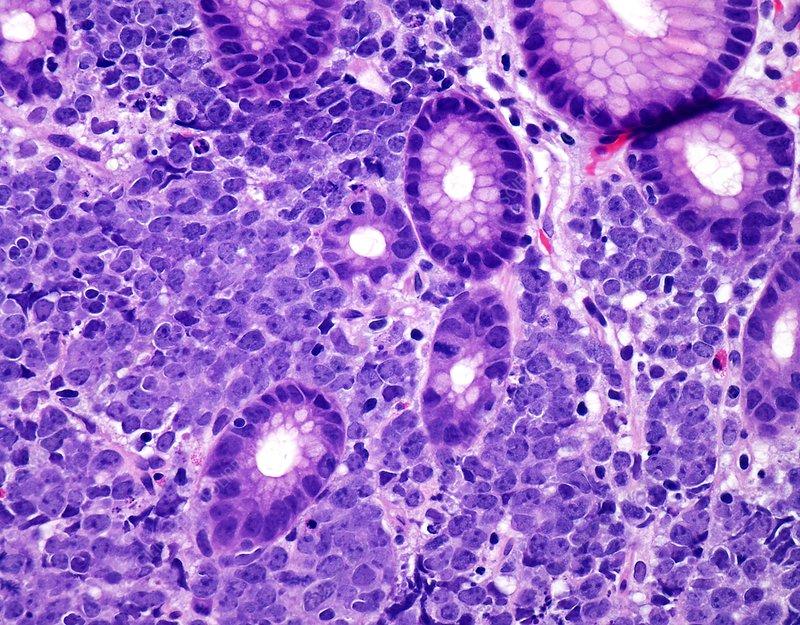 United States Diffuse Large B-cell Lymphoma Therapeutics Market Set to Reach USD 7.2 Billion by 2031 | DataM Intelligence