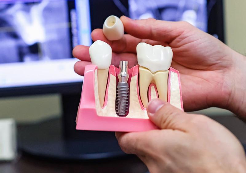 Dental Implants Market to hit US$ 10.22 Billion by 2033 | Leading Companies 2025 - BioHorizons, Nobel Biocare Services AG, ZimVie Inc., OSSTEM IMPLANT CO., LTD., Institut Straumann AG