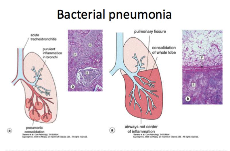 Bacterial Pneumonia Market Size, Share & Trends | Global Forecast 2031