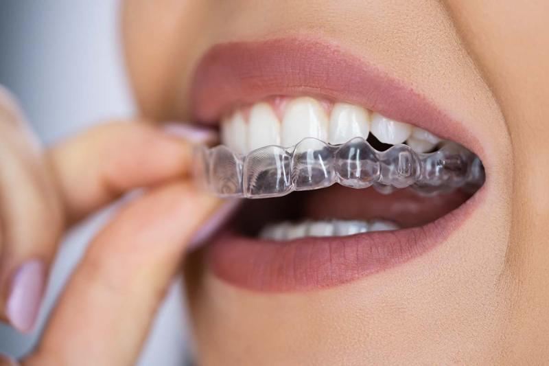 United States Clear Aligners Market Outlook 2031 | Trends, Growth Drivers, and Industry Analysis 2025 | Top Companies are Align Technology, Inc., Danaher, Institut Straumann AG