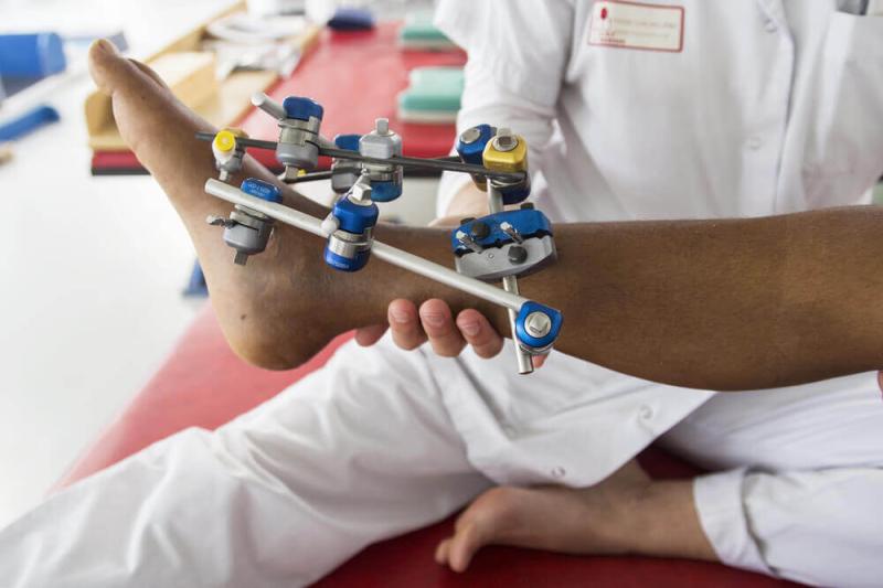 Trauma Fixation Devices Market Outlook: Bioabsorbable Implants, 3D Printing, and Minimally Invasive Solutions | Top Companies are Stryker Corporation, Johnson & Johnson, Cardinal Health Inc.