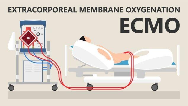 ExtraCorporeal Membrane Oxygenation Market Forecast 2025-2032: Innovations and Increasing Critical Care Demand