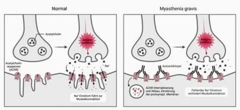 US Myasthenia Gravis Therapeutics Market Size to Reach USD 2.12 Billion by 2032 Fueled by Rising Diagnosis Rates