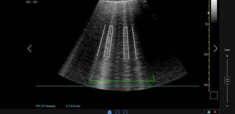 The Global Point-of-Care Lung Ultrasound Imaging Market is projected to reach a market size of USD 743.28 million by the end of 2030