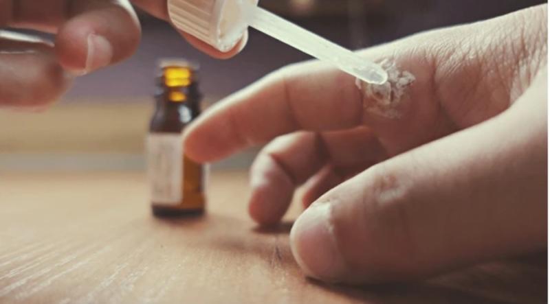 Essential Oils That Help Fade Warts Fast