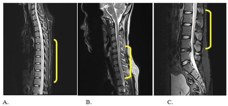 Transverse Myelitis