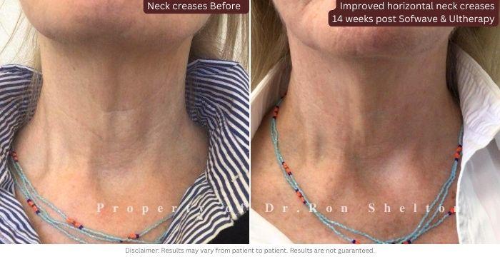 Improved horizontal neck creases 14 weeks post Sofwave and Ultherapy