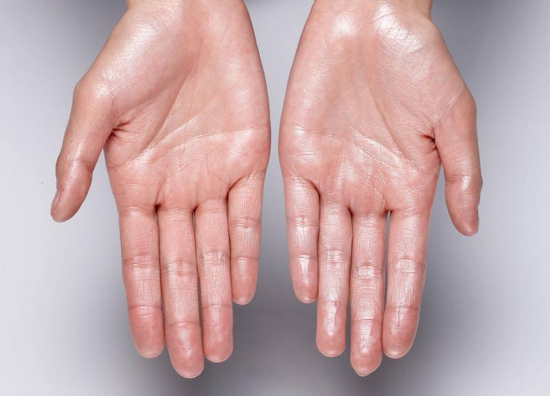 Hyperhidrosis Treatment Market : A Study of the Current Status