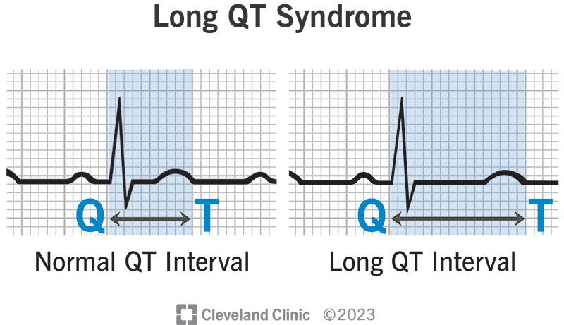 Long QT Syndrome