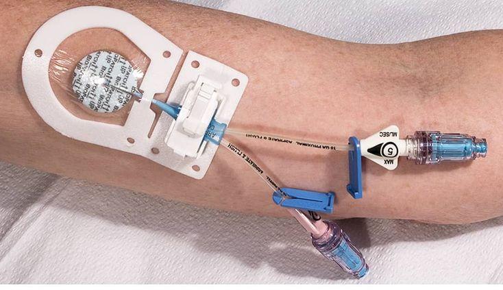 Catheter Stabilization Devices Market Key Trends, Innovations, and Growth Opportunities for 2024- 2033
