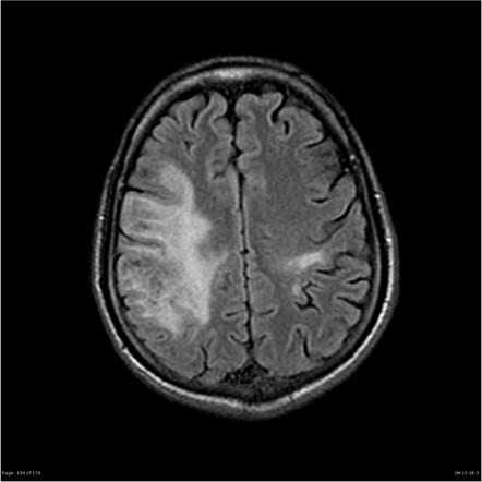 Progressive Multifocal Leukoencephalopathy