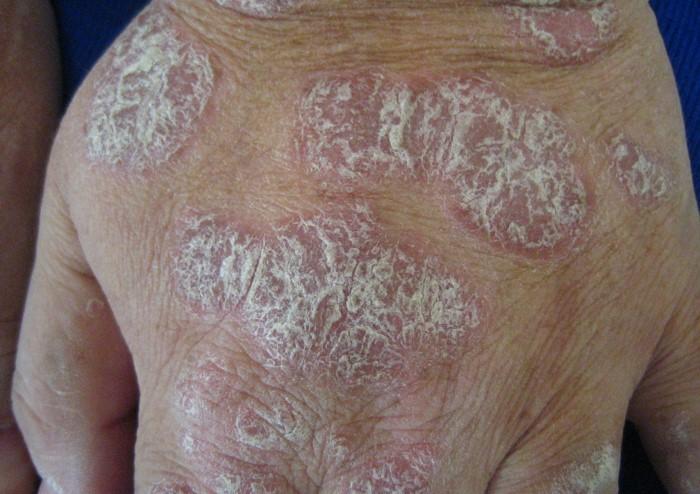 Moderate to Severe Psoriasis