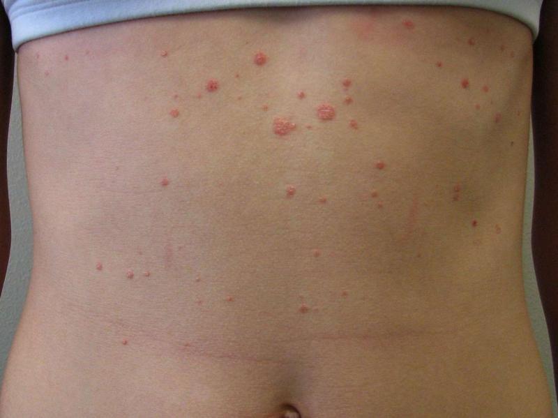 Moderate Psoriasis