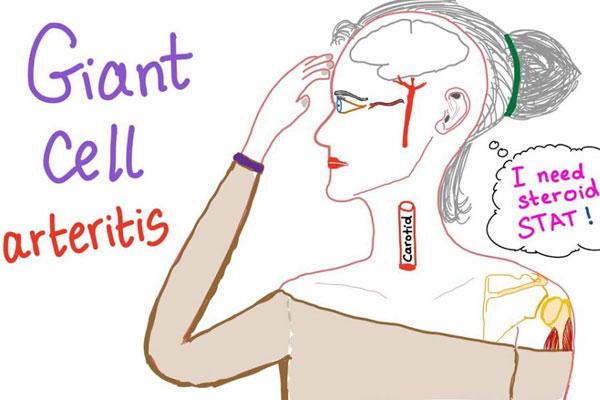 Giant Cell Arteritis