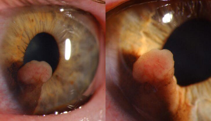 Iris Melanoma