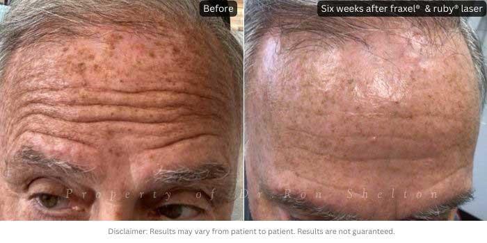Six weeks after fraxel® & ruby® laser for brown spots