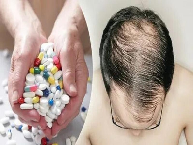Hair Loss Medication