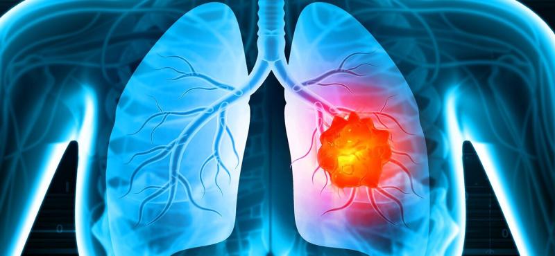 Lung Cancer Therapeutics Market