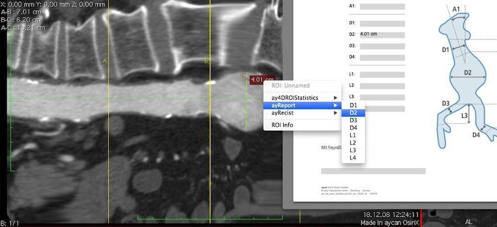 Direct reporting in aycan OsiriX PRO.