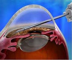 Glaucoma Surgery Devices Market 2016: Glaucoma Systems,