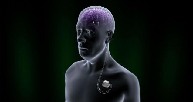 Neurostimulation Devices Market, Neurostimulation Devices, Neurostimulation Devices, Neurostimulation Device market