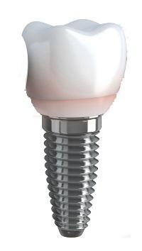 Dental Implants – Promise of Hassle-free, Everlasting Teeth