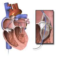 Balloon Valvuloplasty Device