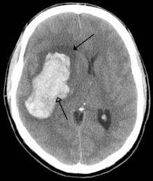 Ischemic Cerebral Stroke Prevention Therapeutics