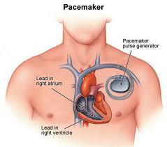 Cardiac Pacemakers Market Size 2017-2022: Medtronic, Biotronik, Boston Scientific, St.Jude Medical