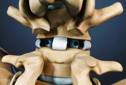 Spinal Fusion Market Size 2017-22: Invibio, SCIENTX, MicroPort, Zimmer, Medtronic, Trauson