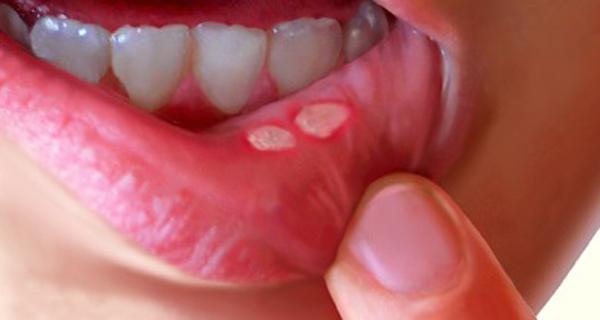 Global Mouth Ulcer Treatment Drug Market 2017 -