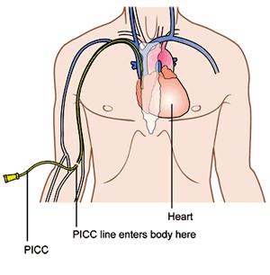 Global Peripherally Inserted Central Catheter Market Research Report Forecast 2017 to 2021