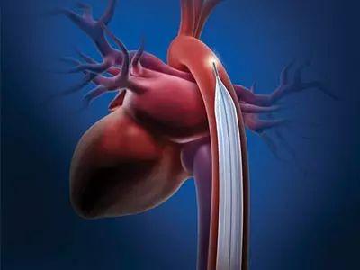 Intra-aortic Balloon Pump (IABP) Market