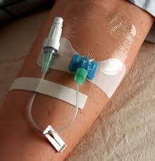 Catheter Stabilization Device Market Report for Period 2017 till 2023 Merit Medical Systems, Halyard Health, Inc, Dale Medical, Centurion Medical Products and Others