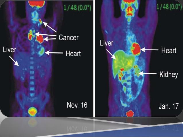 Positron Emission Tomography (PET) Scanners