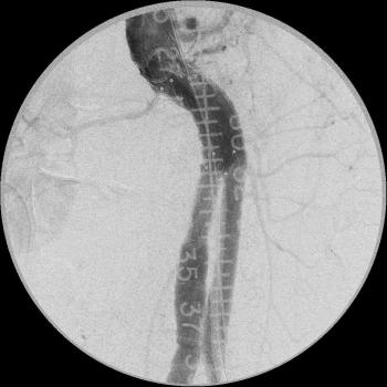 Stent Grafts Market