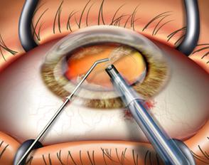 Ocular Surgery Market to Surge Past US$ 2.6 Billion by 2025 Due