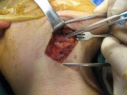 lymph Biopsy