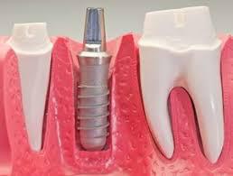 Nov, 21 2017: Cosmetic Implant Market Forecast 2023 Sientra, Allergan, Zimmer Holdings, GC Aesthetics