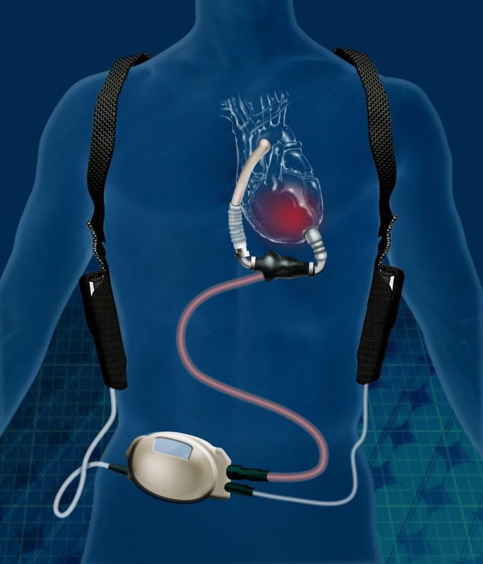 Cardiac Assist Devices Industry | Capacity Production Cost