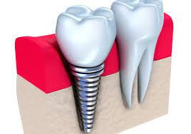 Titanium Dental Implants Market Forecast 2018-2023 Southern Implants, Osstem, Straumann