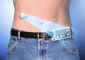 Global Artificial Pancreas Devices Systems Market 2018 - Medtronic, Bigfoot Biomedical, Beta Bionics, Admetsys, Insulet