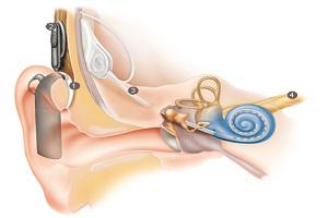 Global Cochlear Implants Market