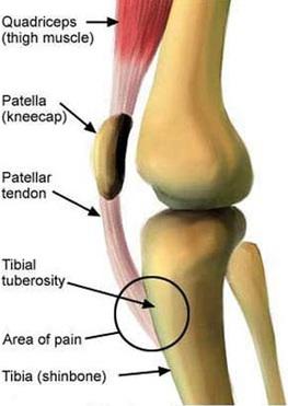 Osgood-Schlatter Market